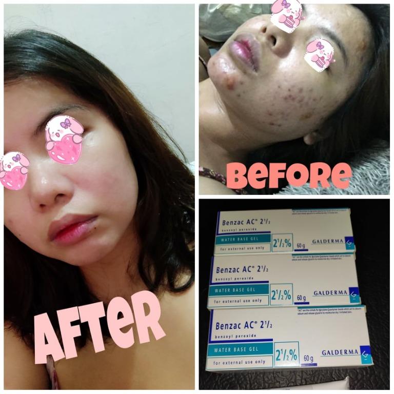 Benzac AC 2.5 Gel - 30g